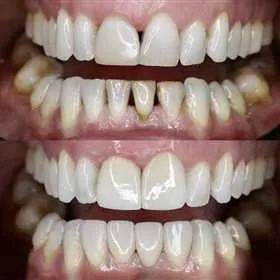 Antes y después de carillas dentales · caso real P&P Clinic Madrid