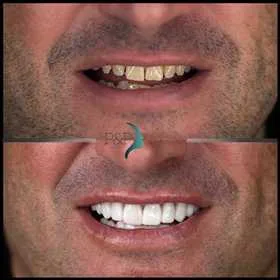 Antes y después de carillas dentales · caso real P&P Clinic Madrid