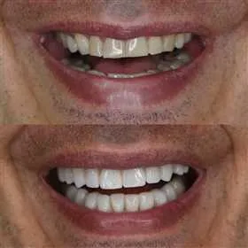 Antes y después de carillas dentales · caso real P&P Clinic Madrid
