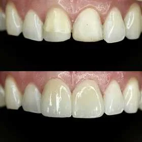Antes y después de carillas dentales · caso real P&P Clinic Madrid