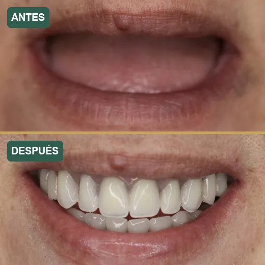 Antes y después de implantes dentales · caso real P&P Clinic Madrid