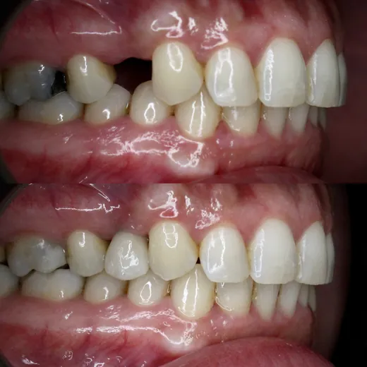Antes y después de implantes dentales · caso real P&P Clinic Madrid