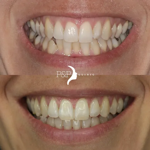 Antes y después de ortodoncia invisible Invisalign · caso real P&P Clinic Madrid