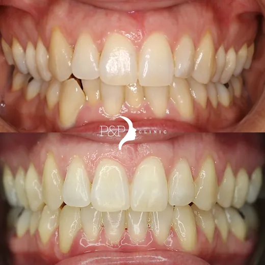 Antes y después de ortodoncia invisible Invisalign · caso real P&P Clinic Madrid