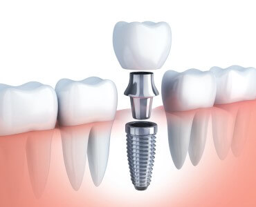 Implantes dentales en Madrid