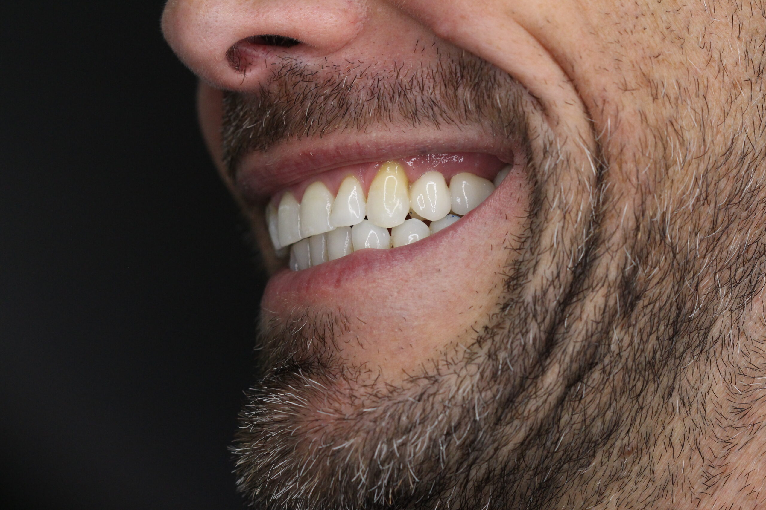 Invisalign landing